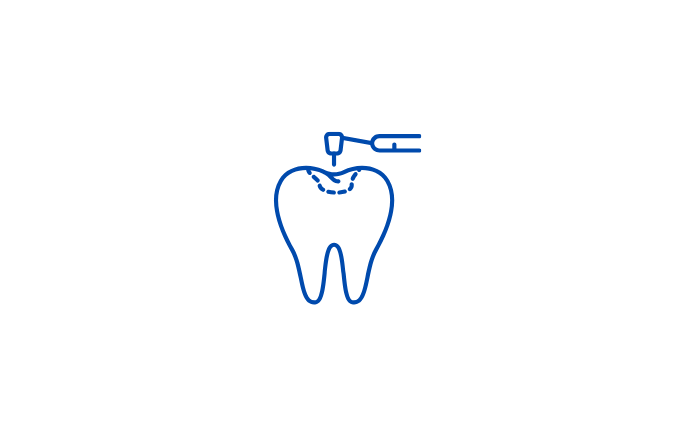 Cavities and fillings